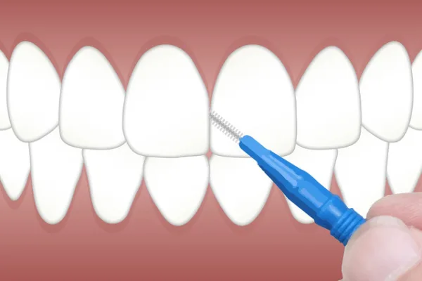 Implanty zębów – faza gojenia