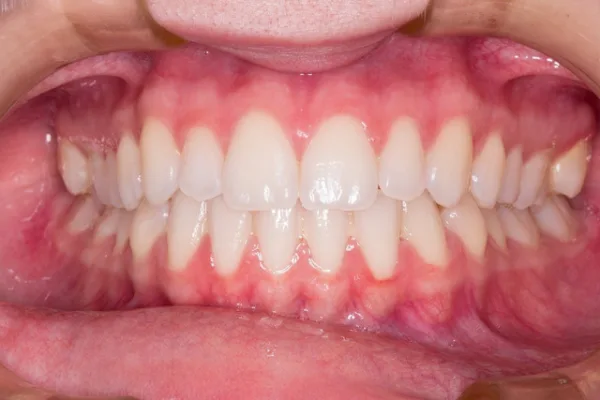 Jak można wyprostować jeden ząb za pomocą aparatu ortodontycznego?