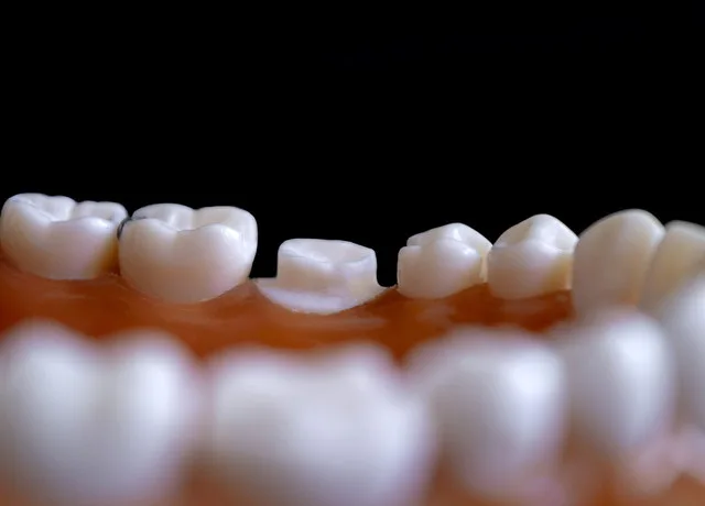 Próchnica zębów - przyczyny występowania